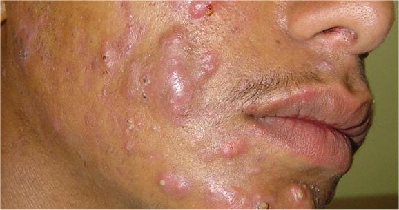 acne-2