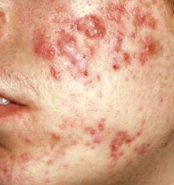 acne-3