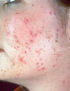 acne-4